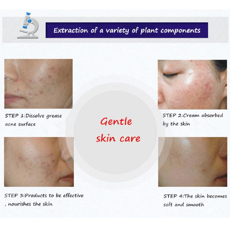BIOAQUA Anti Acne Cream Acne Scar Removal Cream