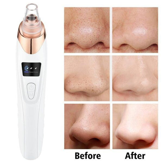 5 in 1 Rechargeable Blackhead Remover